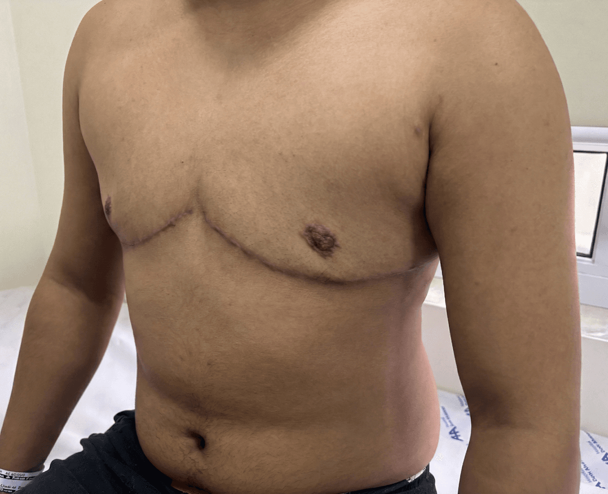 Resultado de mastectomia masculinizadora - Caso 4